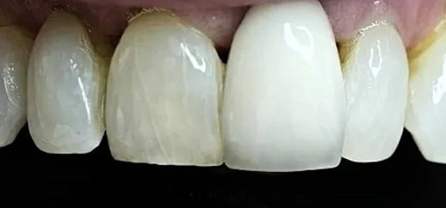 Dental sealant before Burbank Dentist