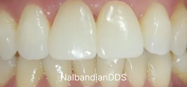 Dental bonding after treatment  at Burbank Dental office