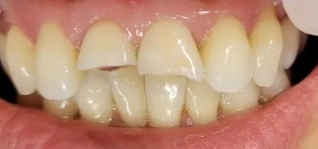 Dental bonding before at Burbank Dental office