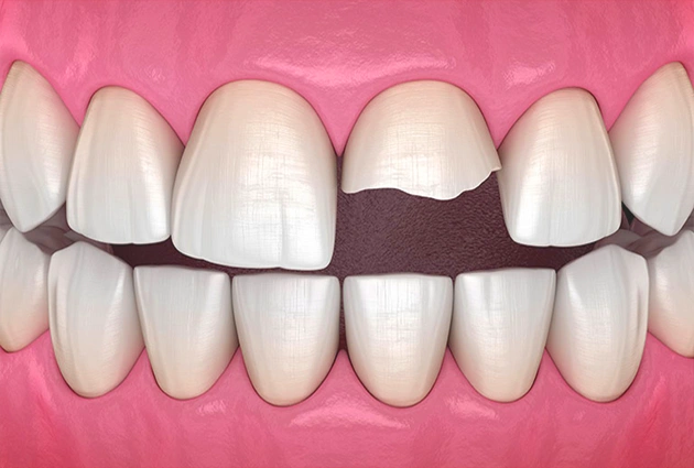 Cracked teeth treatment at Burbank dentist