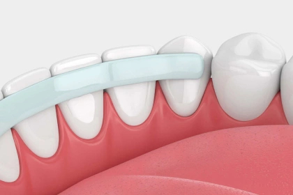 Dental bonding treatment in Burbank dentist 