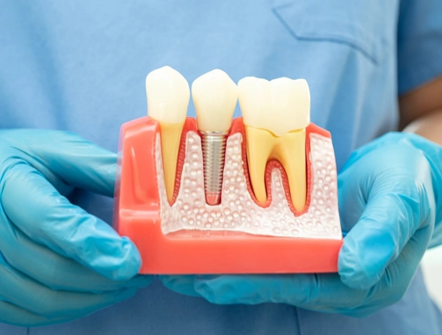 Dental implants held in dentist’s hand at office