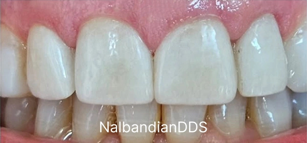 Dental veneers after  in Burbank Dentist 