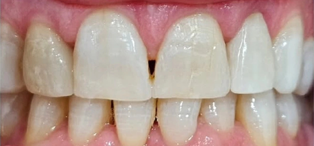 Dental Veneers before  in Burbank Dentist 