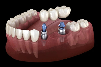 Dental crowns and bridges treatment at a Burbank dental office