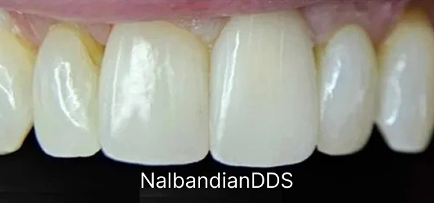 Dental sealant after Burbank Dentist