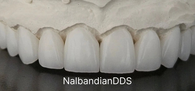Dental veneers in Burbank,CA