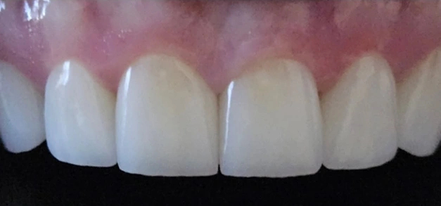 Teeth Whitening in Burbank, CA
