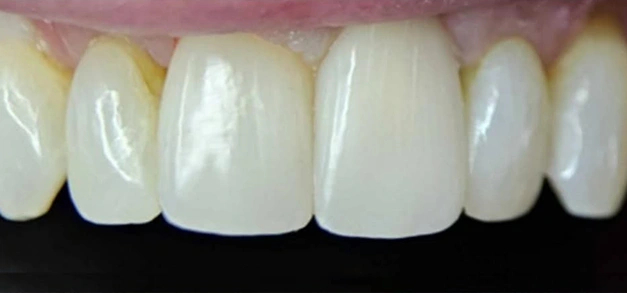 Teeth whitening before at Burbank dentist
