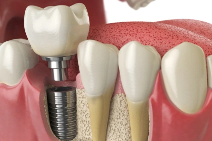 Dental implant procedure at Burbank dentist’s office