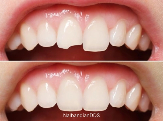 Dental bonding treatment before and after at a Burbank dental office