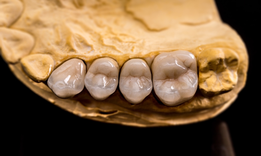 Transform Your Smile: Dental Crowns Explained