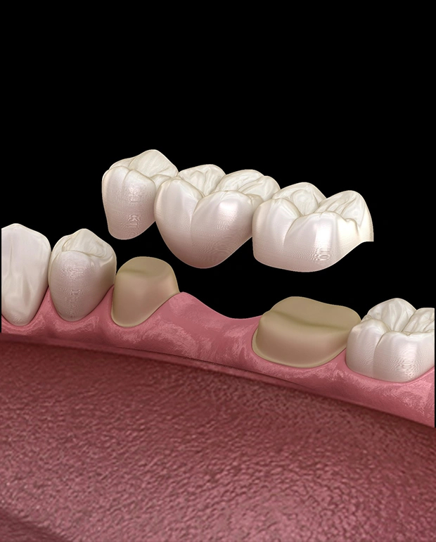 Dental crowns and bridges treatment at a Burbank dental office