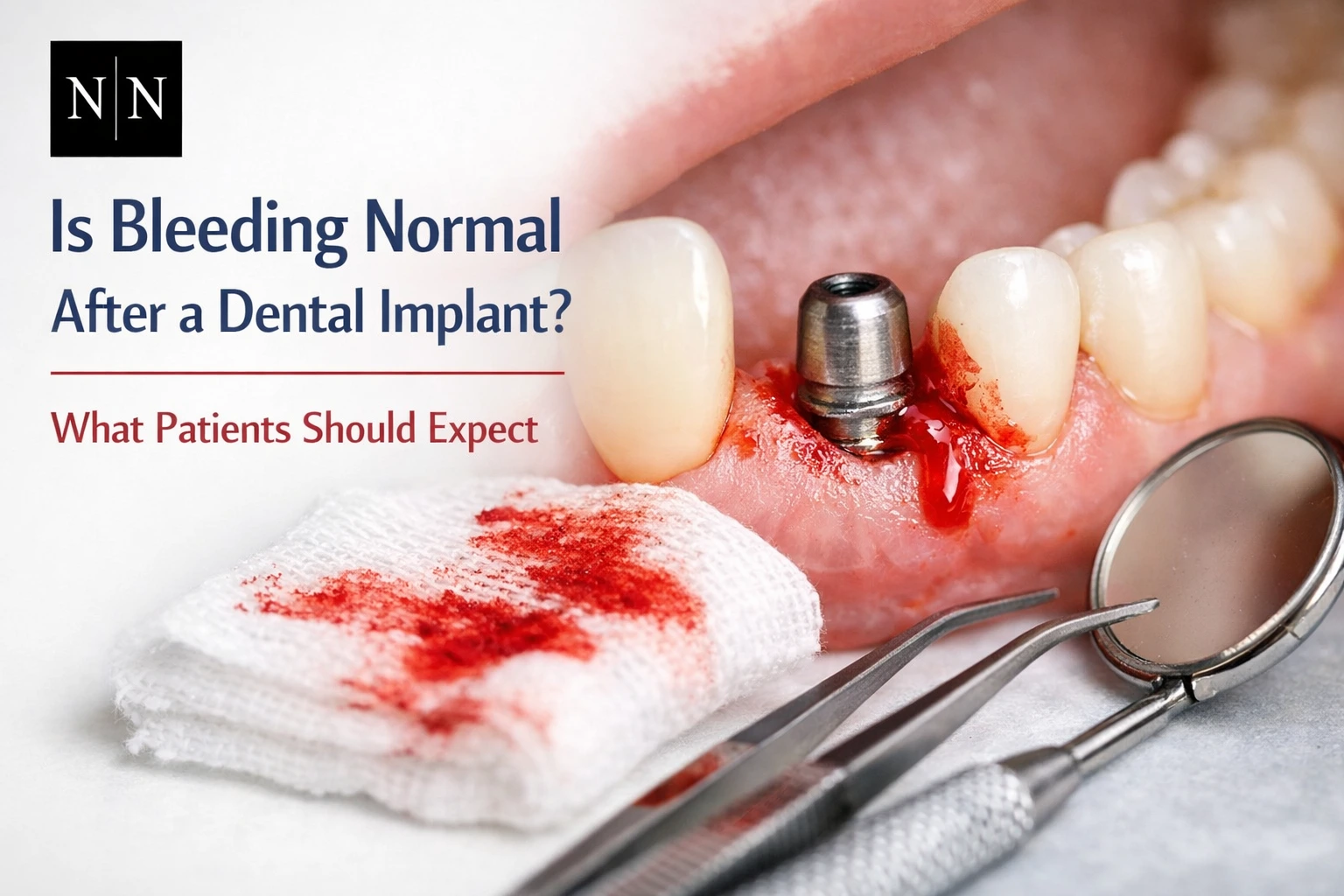 Dental implant bleeding what to expect
