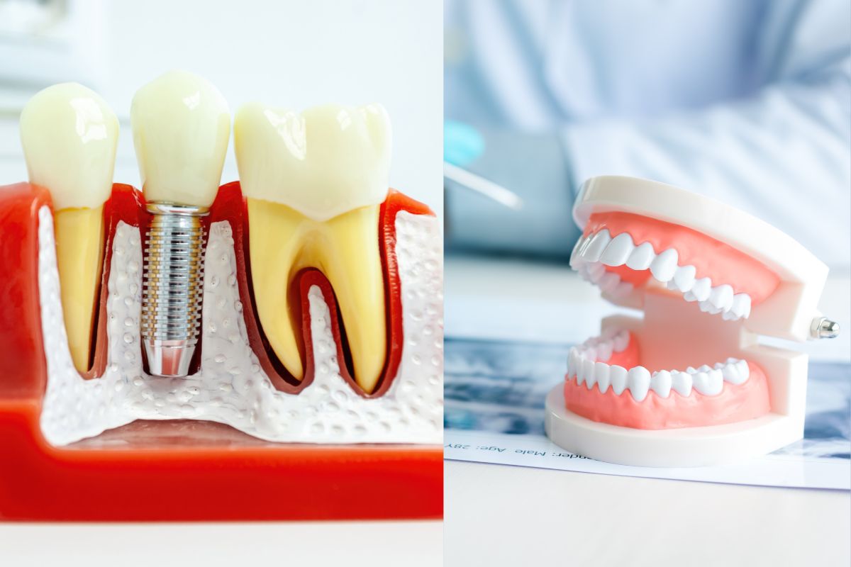 implants vs dentures