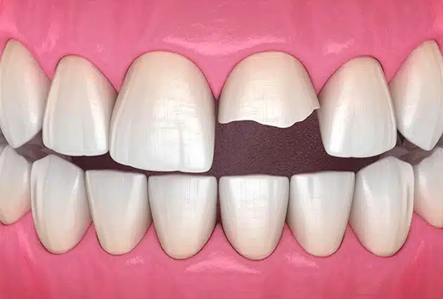 Cracked teeth treatment at Burbank dentist