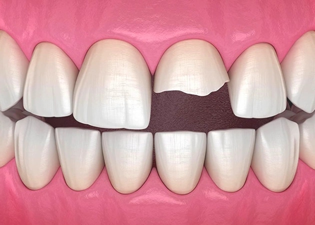 cracked teeth before repair at a dental office in Burbank